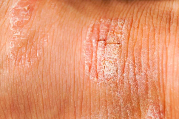 Psoriasis dry red and white irritation on the skin closeup.