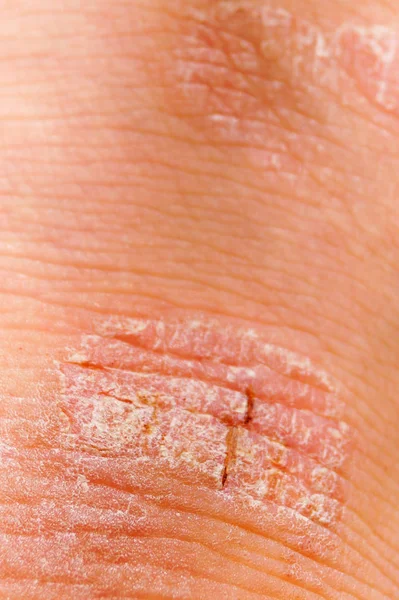 Psoríase irritação vermelha e branca seca no close-up da pele . — Fotografia de Stock