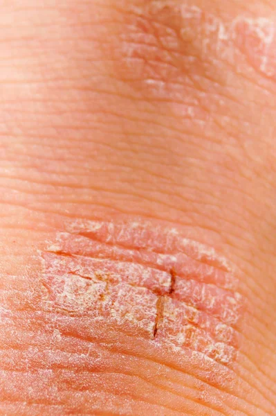 Psoriasis droge rode en witte irritatie op de huid-closeup. Rechtenvrije Stockafbeeldingen