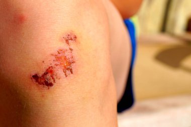 Çökmeden sonra Dizdeki çizik üzerinde kuru kan. Bacak üzerinde yara.