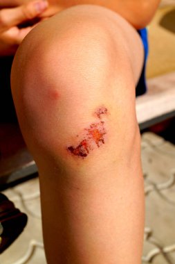 Çökmeden sonra Dizdeki çizik üzerinde kuru kan. Bacak üzerinde yara.