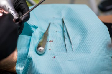 diş çıkarma. Diş office