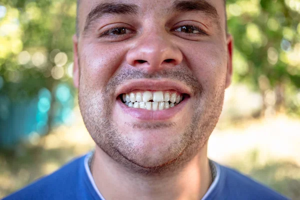 Молодой Человек Голубой Футболке Сломанным Зубом — стоковое фото