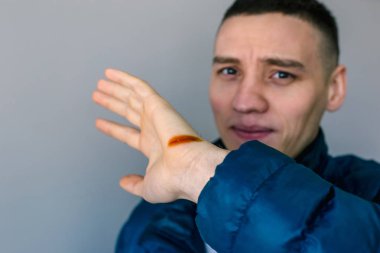 Yaralı eliyle adam ve açık kesim, iyot tedavi.