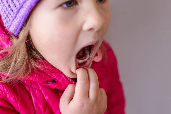 Erwachsene Zähne Die Sich Hinter Babyzähnen Verstecken Haifischzähne Geöffneter Mund — Stockfoto