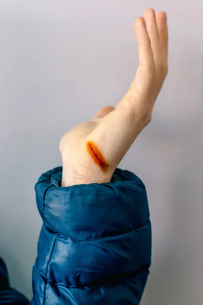 Τραυματίες Χέρι Ανοιχτής Κοπεί Ιώδιο Αντιμετωπίζονται — Φωτογραφία Αρχείου