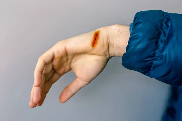 Injured Hand Open Cut Iodine Treated — Stock Photo, Image
