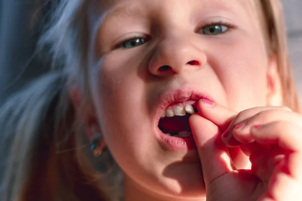 Ein Kleines Mädchen Zeigt Einen Wackeligen Babyzahn Mund — Stockfoto