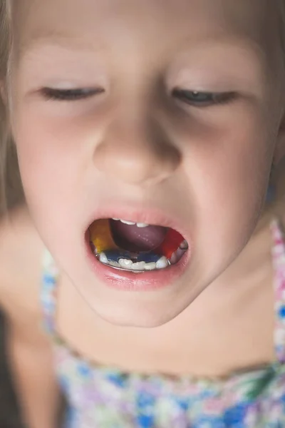 Uma Menina Com Dentes Tortos Mostra Aparelho Ortodôntico Boca — Fotografia de Stock