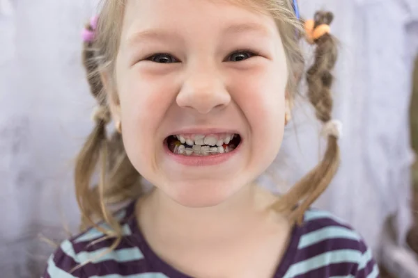 Dientes Permanentes Para Adultos Delante Los Dientes Leche Del Niño —  Fotos de Stock