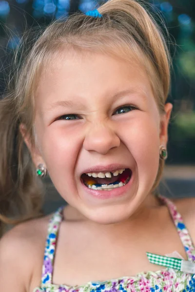 Dziewczynka Ortodoncją Krzywymi Zębami Chwiejny Ząb — Zdjęcie stockowe