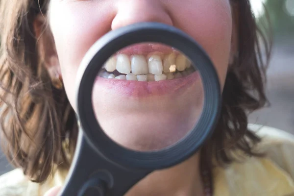 Vrouw Met Vergrootglas Toont Haar Kromme Tanden — Stockfoto