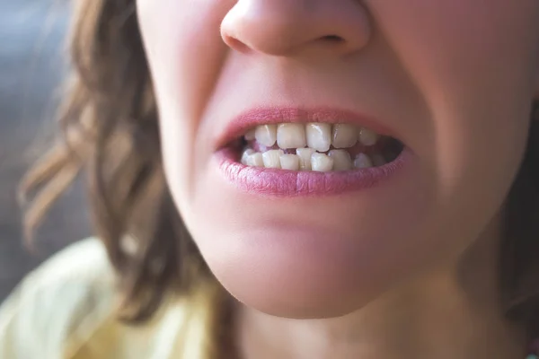 曲がった女性歯の写真 — ストック写真