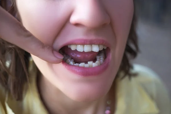 Zdjęcie z kobieta krzywe zęby — Zdjęcie stockowe