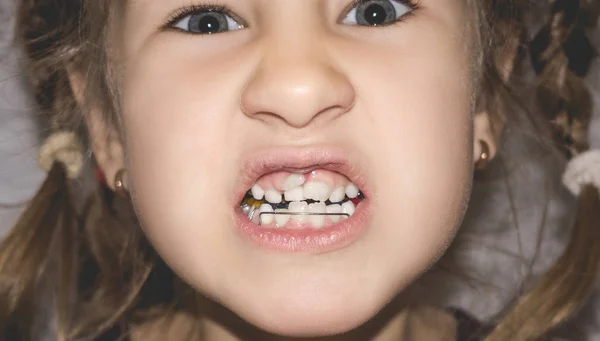 Дорослі постійні зуби, що приходять перед дитячими зубами : — стокове фото