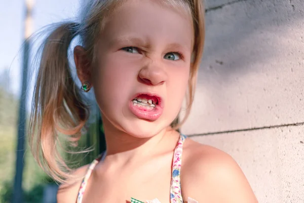 Niña con dientes torcidos y aparato de ortodoncia . —  Fotos de Stock