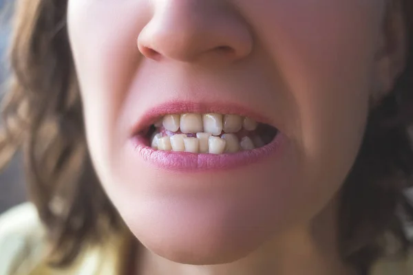 Foto de dientes de mujer torcida — Foto de Stock