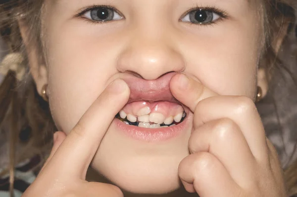Dientes permanentes para adultos delante de los dientes de leche del niño : — Foto de Stock