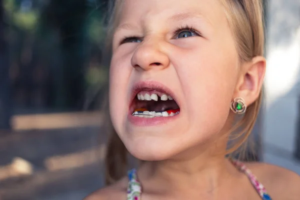 Mała dziewczynka z urządzeniem ortodoncji i krzywym zębami. Wobbl — Zdjęcie stockowe