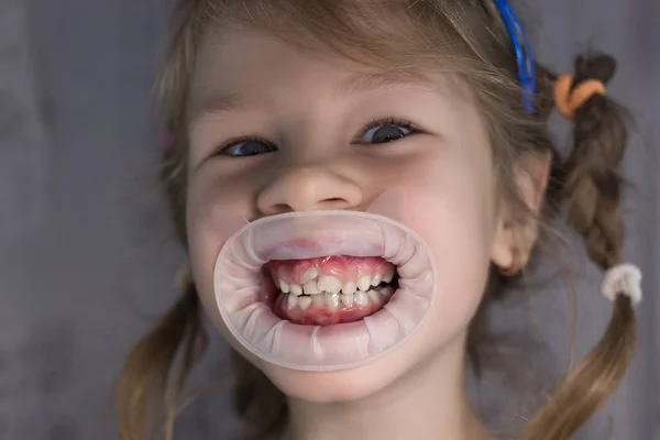 Adultos dentes permanentes que vêm na frente dos dentes de leite da criança : — Fotografia de Stock