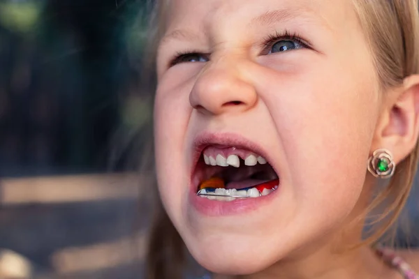 Kleines Mädchen mit Kieferorthopädie-Gerät und schiefen Zähnen. Wackelei — Stockfoto