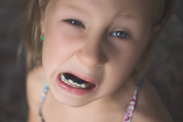 Una niña con dientes torcidos muestra un aparato de ortodoncia —  Fotos de Stock