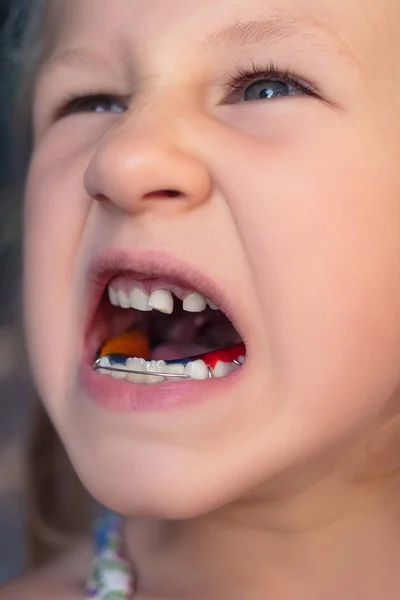 Menina com aparelho ortodôntico e dentes tortos. Wobbl — Fotografia de Stock