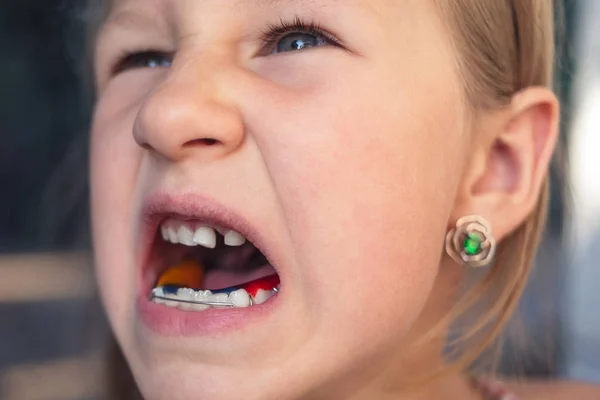 Niña con aparato de ortodoncia y dientes torcidos. Wobbl. —  Fotos de Stock