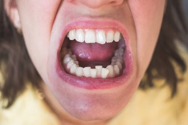 Foto de dientes de mujer torcida —  Fotos de Stock