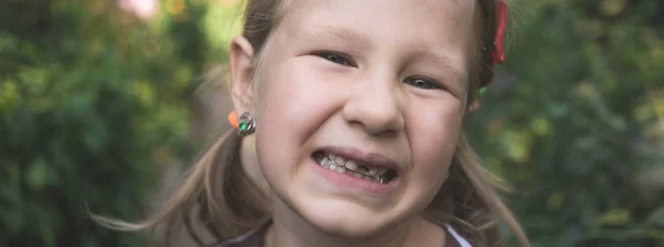 Criança com dispositivo ortodôntico dentário e sem um dente — Fotografia de Stock