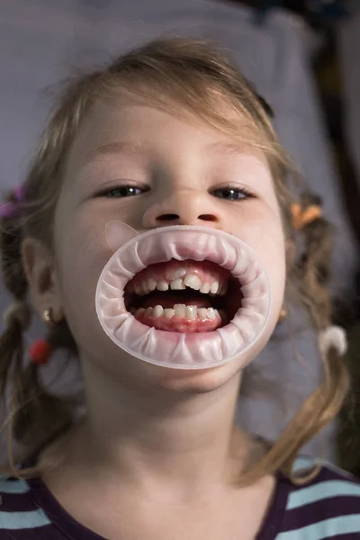 子供の赤ちゃんの歯の前に来ている大人の永久歯: — ストック写真