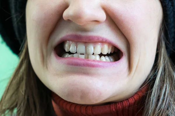 구부러진 이빨 — 스톡 사진