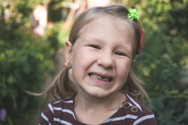Criança com dispositivo ortodôntico dentário e sem um dente — Fotografia de Stock