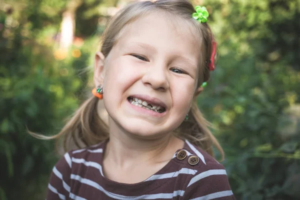 Kind met een gebit orthodontisch apparaat en zonder een tand — Stockfoto