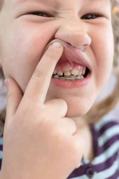 Dientes permanentes para adultos delante de los dientes de leche del niño : —  Fotos de Stock