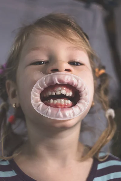 Dientes permanentes para adultos delante de los dientes de leche del niño : —  Fotos de Stock