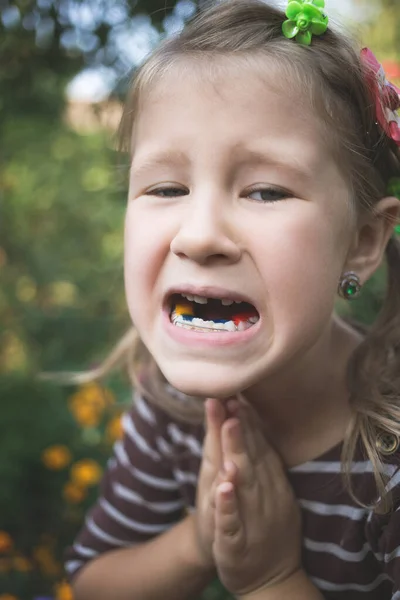 Kind Mit Kieferorthopädischem Gerät Und Ohne Einen Zahn — Stockfoto