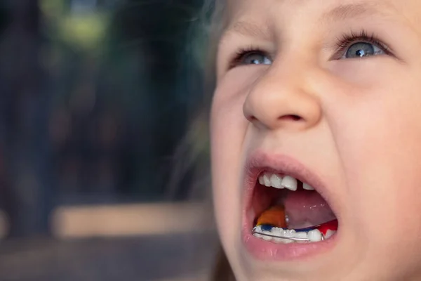 Niña Con Aparato Ortodoncia Dientes Torcidos Diente Tambaleante —  Fotos de Stock