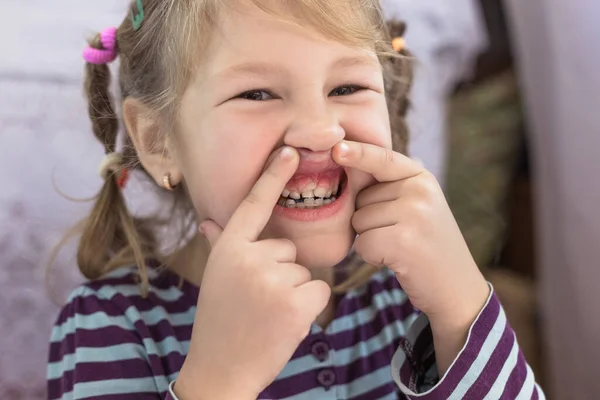 Dientes Permanentes Para Adultos Delante Los Dientes Leche Del Niño —  Fotos de Stock