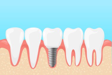 İnsan diş ve diş implantı vektör Illustration. Tıp Diş hekimleri diş bakımı düz çizgi film tarzı kavramı.