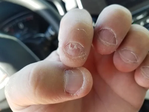Desagradável nojento mordido e descascando unhas no carro — Fotografia de Stock