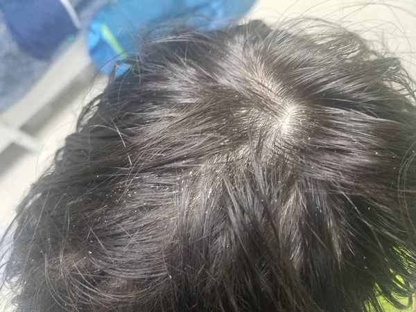 Criança cabelo castanho com piolhos brancos ou caspa — Fotografia de Stock