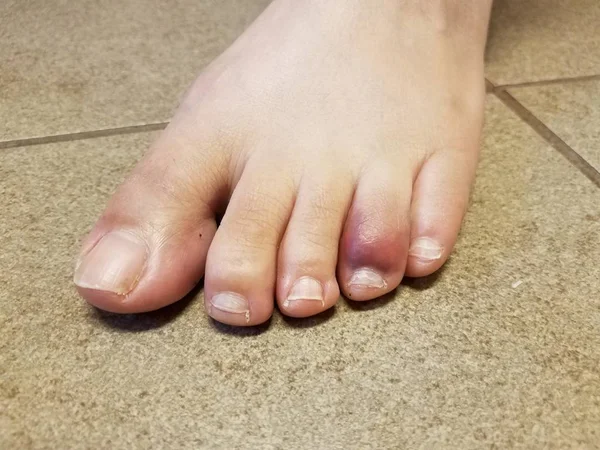 Womans red and purple bruised toe on tile floor — Stock Photo, Image