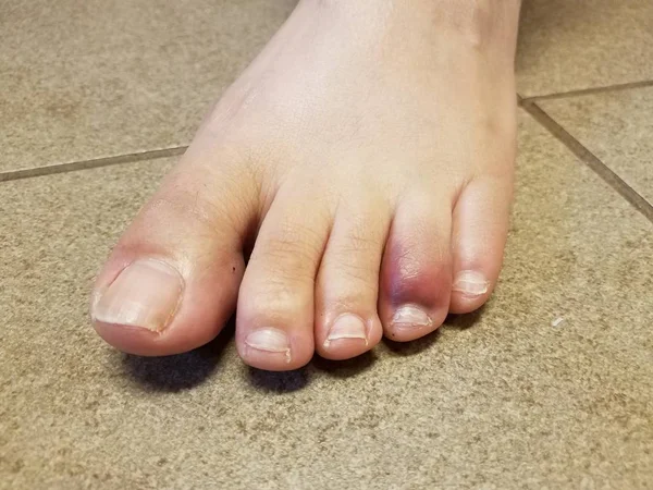 Womans red and purple bruised toe on tile floor — Stock Photo, Image