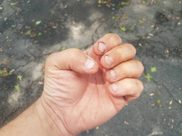 Mano Sucia Las Uñas Con Las Uñas Gruesas Mordidas Cortas —  Fotos de Stock