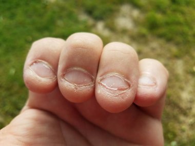 İğrenç, sağlıksız, iğrenç, çiğnenmiş tırnaklar kötü alışkanlık.