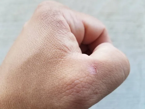 Puño Cerrado Del Hombre Con Ampolla Pequeña Cerca Del Pulgar — Foto de Stock