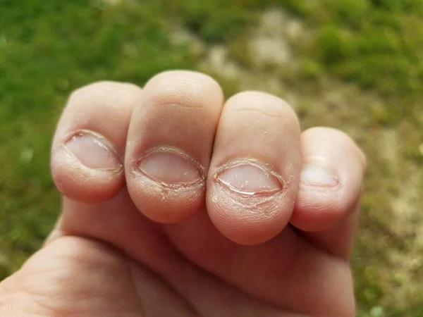 Bitten Nasty Unhealthy Gross Chewed Short Fingernails Bad Habit — Stock Photo, Image