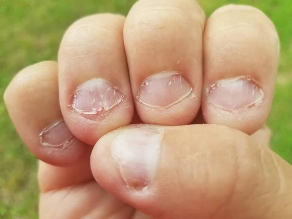 Ekelhaft Gebissen Und Fingernägel Der Hand Des Mannes Gekaut — Stockfoto