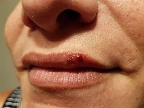Inchaço vermelho ou dor no lábio superior das mulheres — Fotografia de Stock